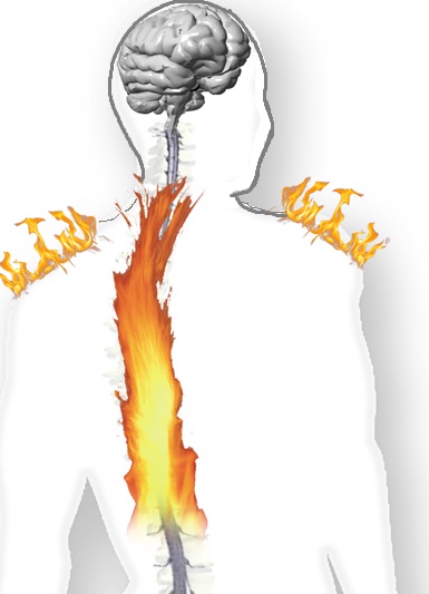 spinal-cord-injury-pain